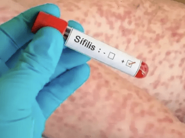 Fuerte aumento de casos de sífilis en San&nbsp;Juan