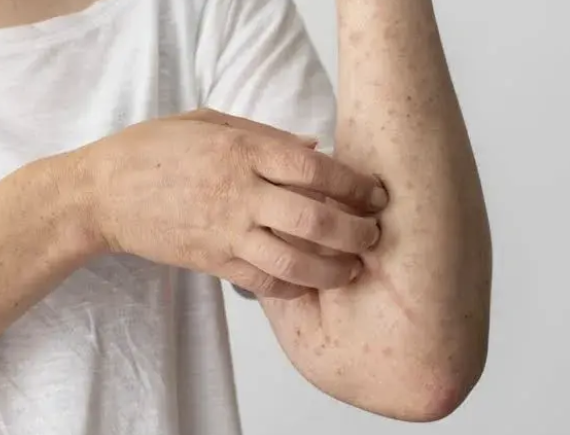 San Juan confirmó un caso de mpox y ya son cuatro los nuevos contagios en Argentina